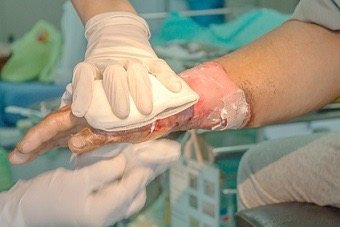 Clinical photograph: a gloved clinician holding WoundClot gauze against an open forearm wound, applied dry and directly to the bleeding surface.
