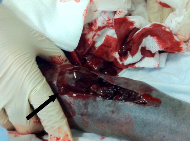 Clinical photograph: the translucent WoundClot gel matrix formed over a wound bed, indicated by an arrow, adhering to the surrounding tissue.