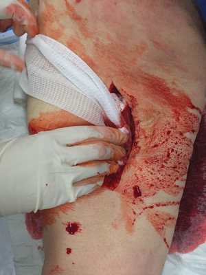 Clinical photograph: WoundClot gauze being packed into a deep bleeding laceration with hand pressure only.